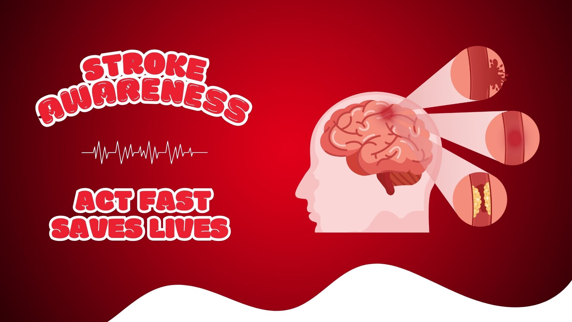 Act quickly to save lives - Stroke Awareness Campaign video Development